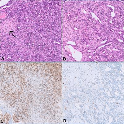 Metastatic mesenchymal chondrosarcoma showing a sustained response to cabozantinib: A case report